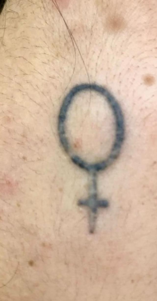 Tatuagem antes da remoção