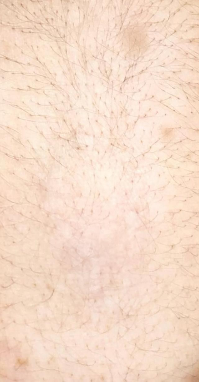 Pele após a remoção completa da tatuagem