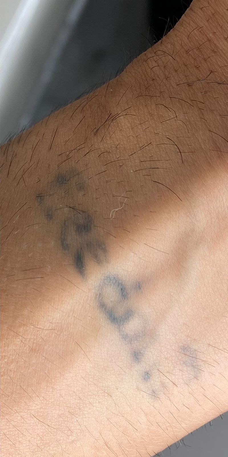 Tatuagem clareada após sessões de laser