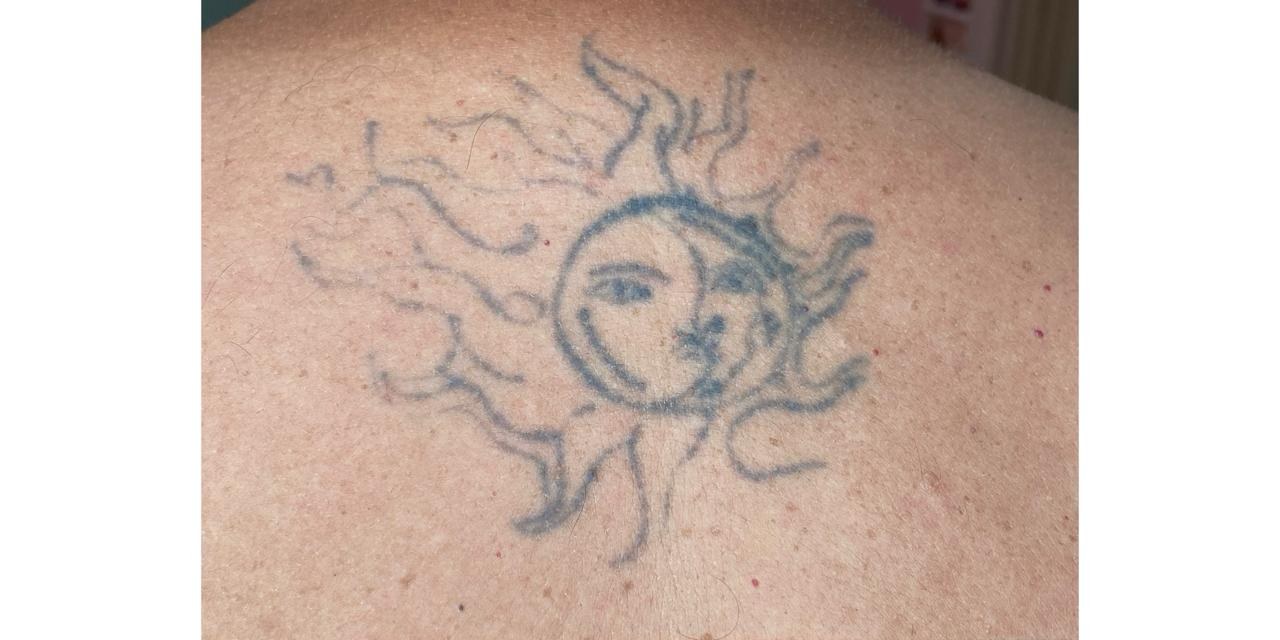 Tatuagem nas costas antes da remoção