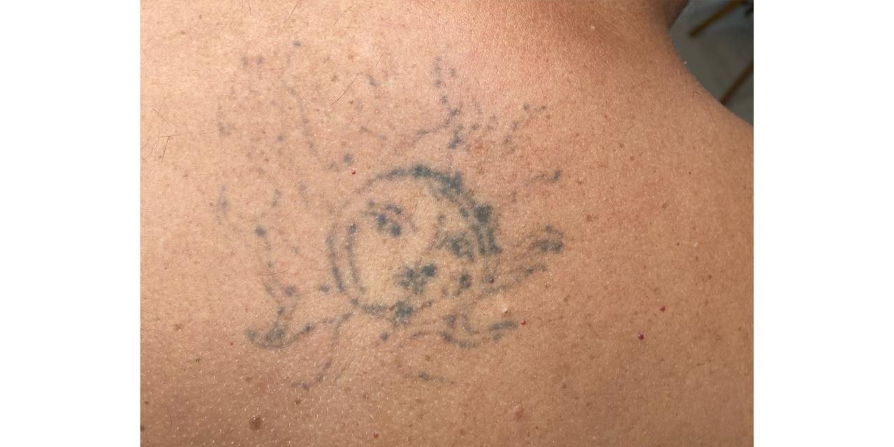 Tatuagem nas costas clareada após o laser